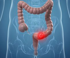 Colon cancer, computer artwork.